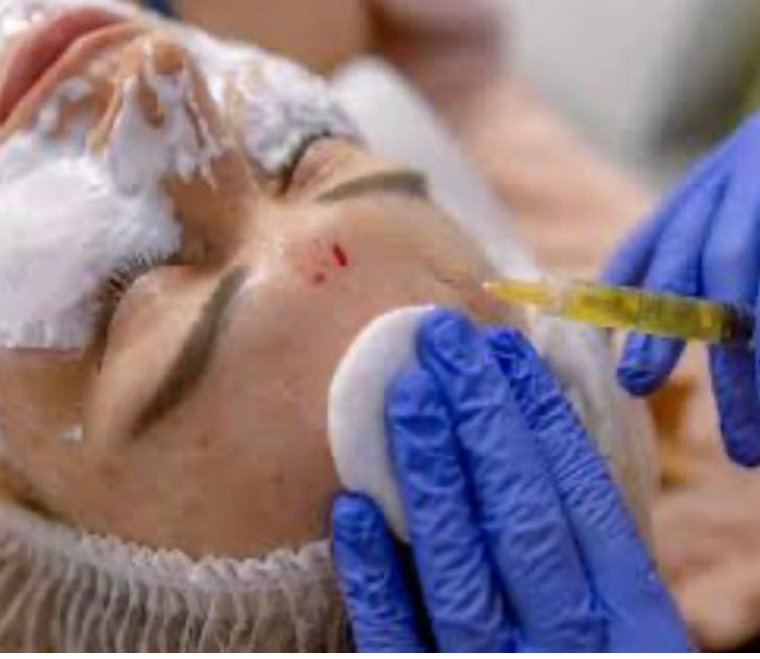 3 Women Diagnosed With HIV After Recieving  “vampire facials.” Treatment